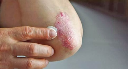 Psoriasis : Le dépistage précoce limite les effets secondaires et garantit une vie normale aux patients