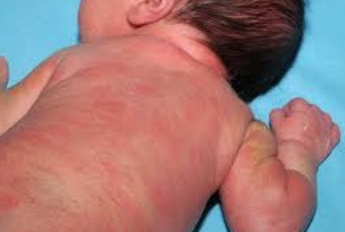 Table ronde à Lâayoune sur les inflammations cutanées chez les nouveau-nés