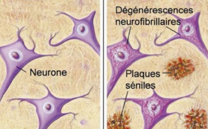 Près de 150.000 Marocains souffrent de la maladie d’Alzheimer