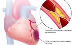 L’infarctus du myocarde en débat à Marrakech