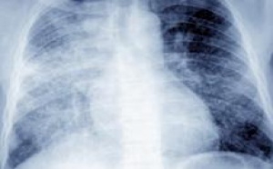 Stratégie «Halte à la tuberculose» : Détection et prise en charge gratuite de 25.000 nouveaux cas