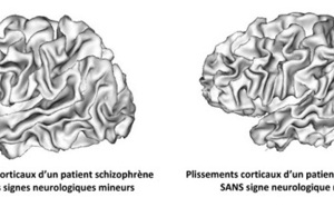 Schizophrénie : la piste des plis cérébraux