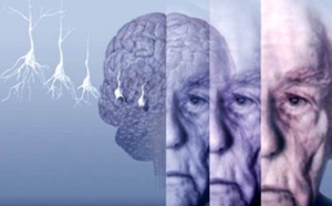 Alzheimer: une étude invalidée par quatre groupes de chercheurs