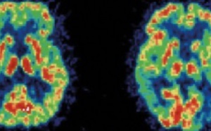 Alzheimer : bientôt un diagnostic simplifié et fiable