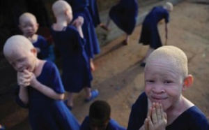 ​Albinos en Tanzanie, une vie de stigmatisation et de violence