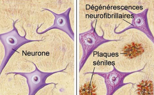 Près de 150.000 Marocains souffrent de la maladie d’Alzheimer