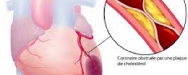 L’infarctus du myocarde en débat à Marrakech