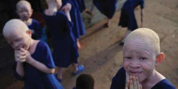 ​Albinos en Tanzanie, une vie de stigmatisation et de violence