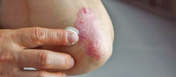 Psoriasis : Le dépistage précoce limite les effets secondaires et garantit une vie normale aux patients